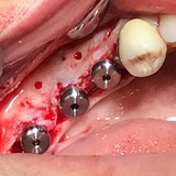 Dr Boostani (Basic implant)