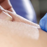 Dry Needling_Q8