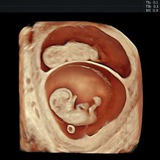 3D & 4D Ultrasound