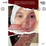Bebas Psoriasis & Ekzema by @Acachiaa