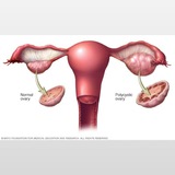 PCOD/PCOS fighters