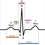 ECG Patterns
